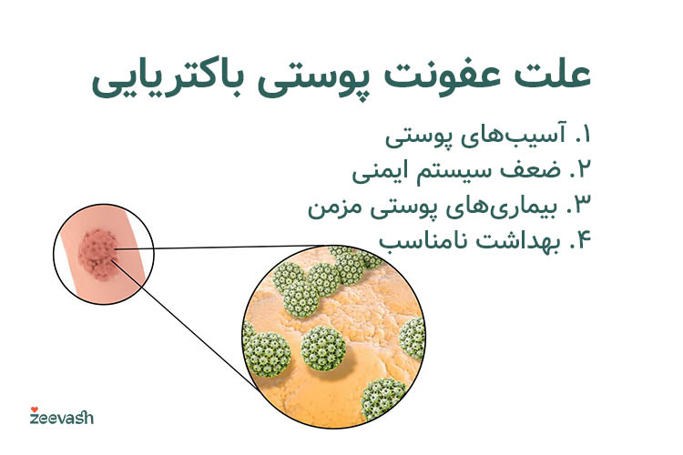 اصلی‌ترین دلایل عفونت پوستی باکتریایی شامل آسیب پوستی، ضعف سیستم ایمنی و بیماری‌های پوستی مزمن است.